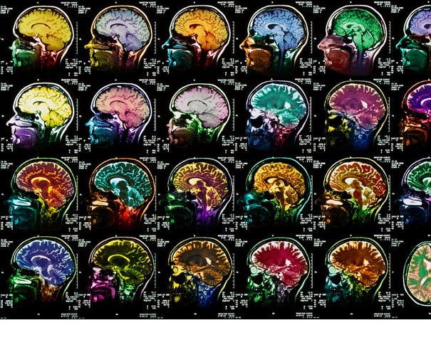 Top clinical trial updates from AAN 2021: stroke and headache